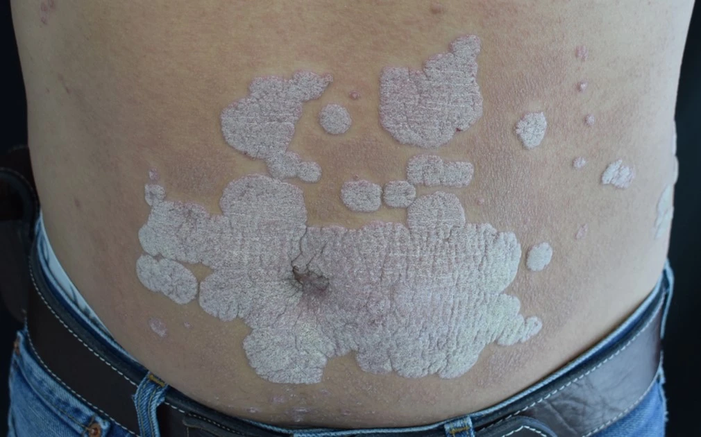 Psoriasis before exciplex treatment - Dr Dalia Rodriguez