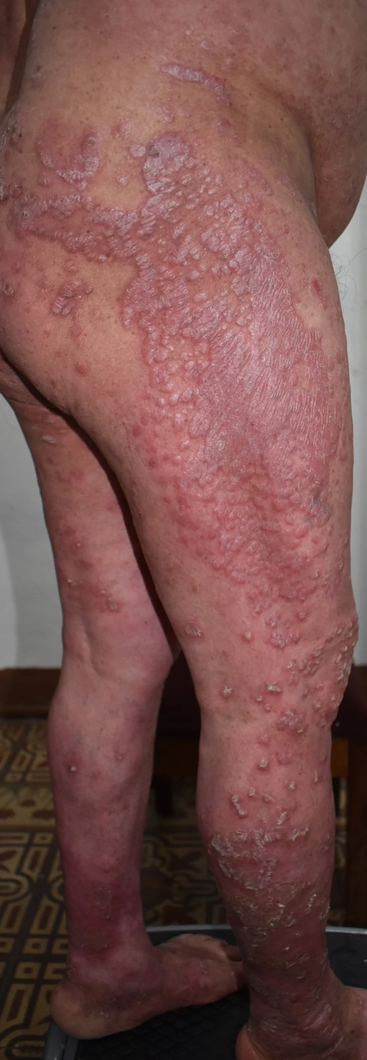 Psoriasis before exciplex treatment - Dr Letona