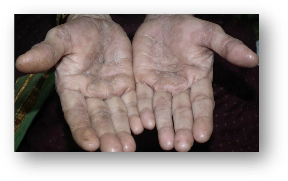 Psoriasis before exciplex treatment - Dr Swapnil Shah