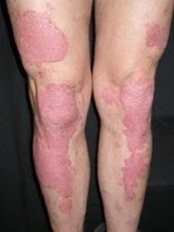 Psoriasis before exciplex treatment - Leone