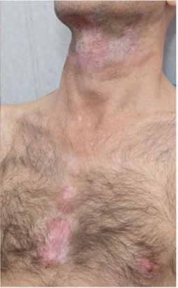 Vitiligo after exciplex treatment - Dr Rita