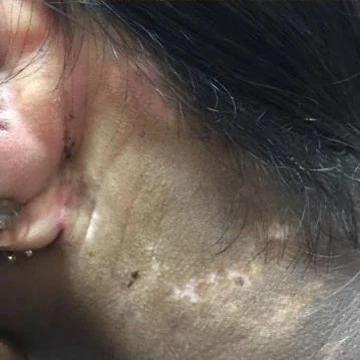 Vitiligo after exciplex treatment - Dr. Ajay DESHPANDE