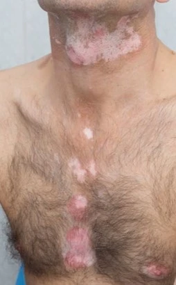 Vitiligo before exciplex treatment - Dr Rita