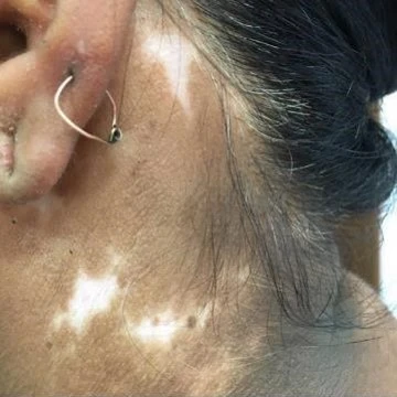 Vitiligo before exciplex treatment - Dr. Ajay DESHPANDE